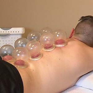 Cupping: Does it work? -