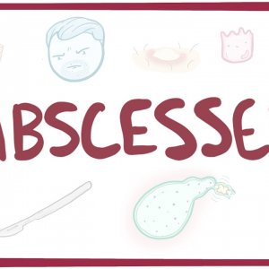 Abscesses - causes, symptoms, diagnosis, treatment, pathology